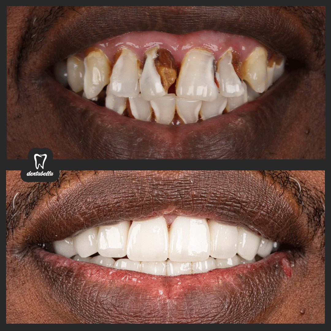 before-after-ftoto_01