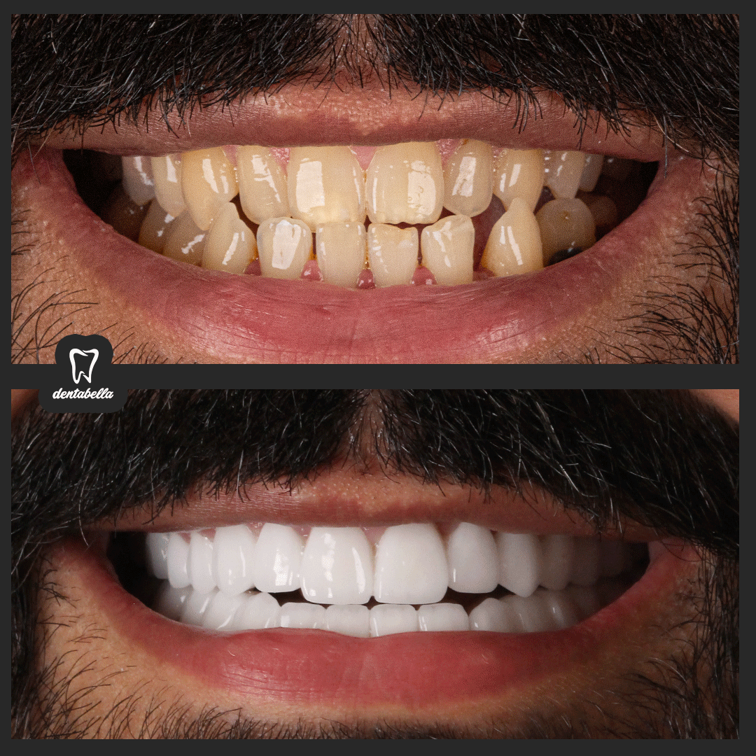 before-after-ftoto_02