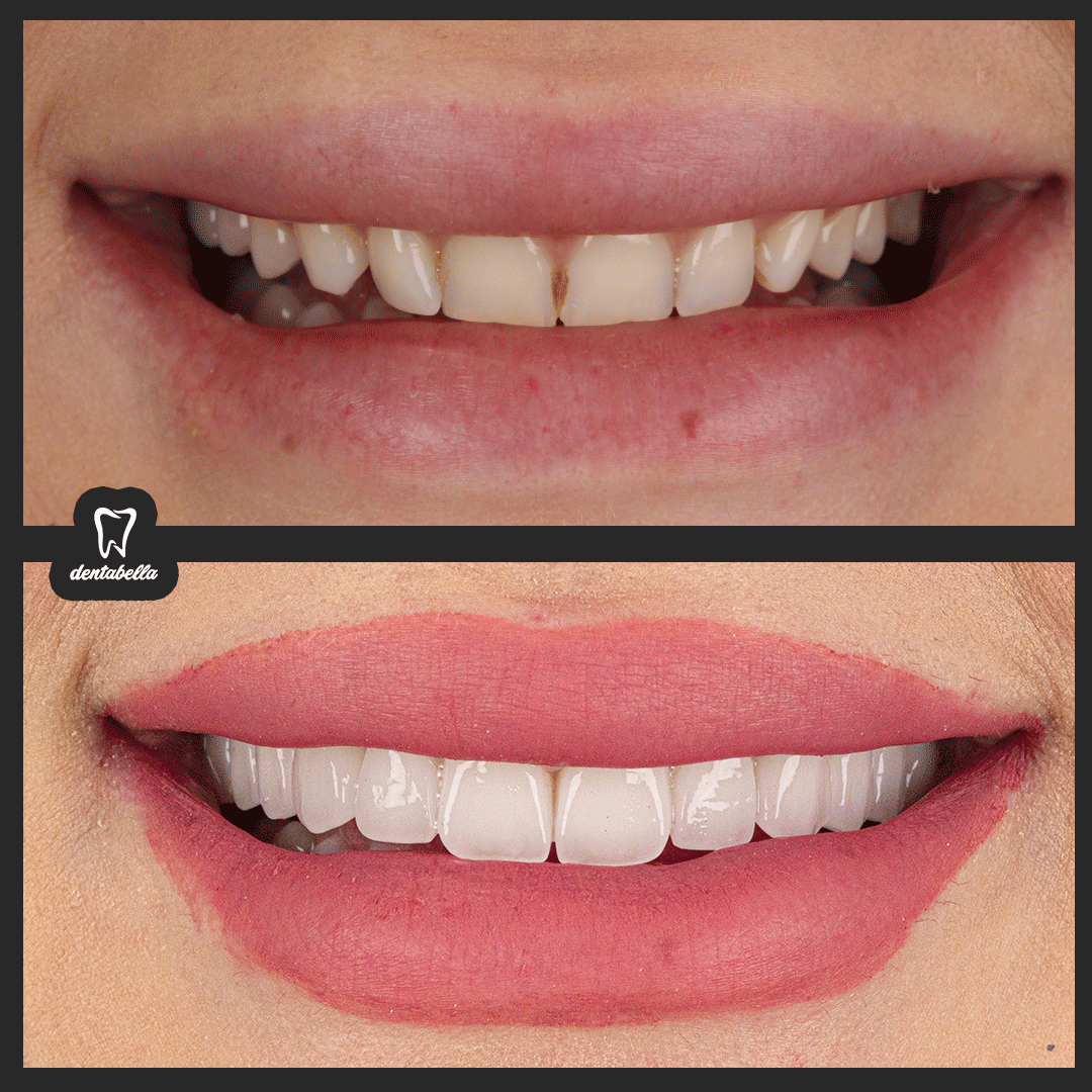 before-after-ftoto_03