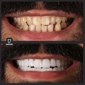 before-after-ftoto_02