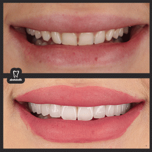 before-after-ftoto_03